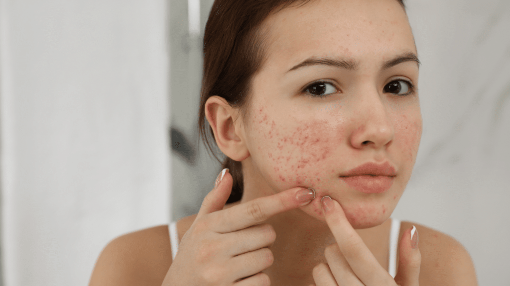 girl with acne touching her face